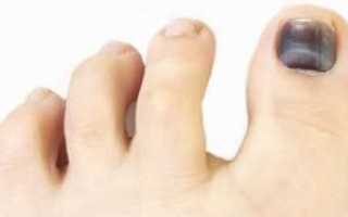 При сахарном диабете чернеют ноги