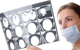 Симптомы кисты мозга у взрослого и чем опасна?