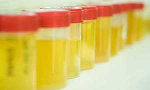 Определение сахара в моче у детей и чем опасно его обнаружение?