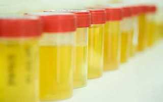 Определение сахара в моче у детей и чем опасно его обнаружение?