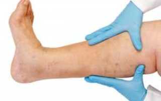 Почему болят ноги при сахарном диабете