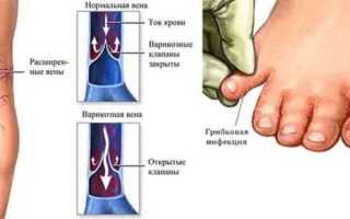 Боли в ногах при сахарном диабете