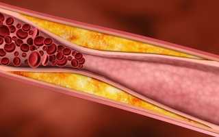 Польза и вред статинов при снижении уровня холестерина