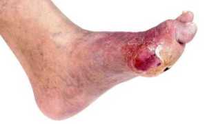 Диабетическая нога — лечение и причины ран на ногах при сахарном диабете