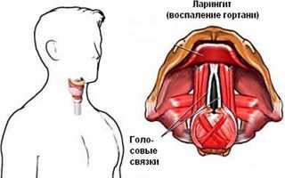 Симптомы и методы лечения катарального ларингита