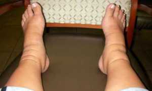 Опухание ног при диабете: причины и методы борьбы с отечностью