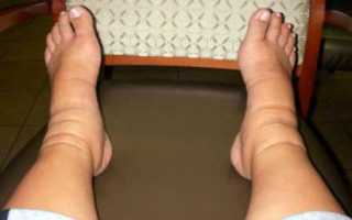 Опухание ног при диабете: причины и методы борьбы с отечностью