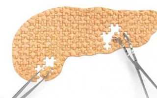 Можно ли умереть от панкреатита и как этого избежать