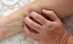 Изменения кожных покровов при панкреатите