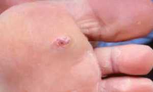 Мази для заживления ран при сахарном диабете