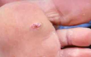 Мази для заживления ран при сахарном диабете