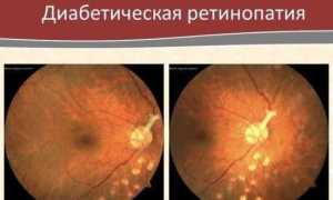 Зрение при диабете