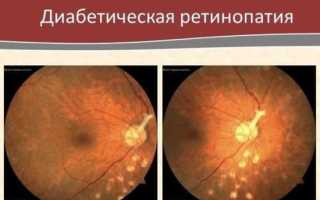 Зрение при диабете