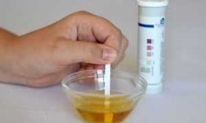 Осложнения при сахарном диабете: ацетон в моче