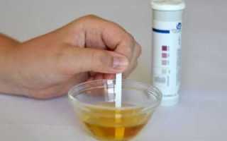 Осложнения при сахарном диабете: ацетон в моче