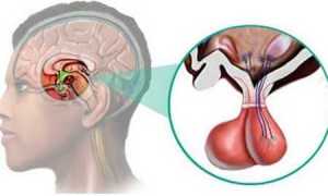 Что такое пролактинома у мужчин и женщин, ее признаки и методы лечения