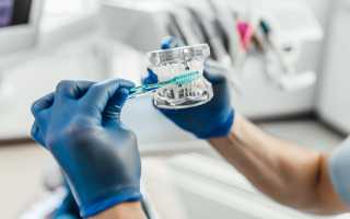 Экспресс-имплантация