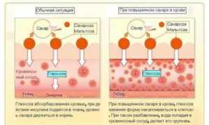 Сахарный диабет — как он проявляется при различных типах