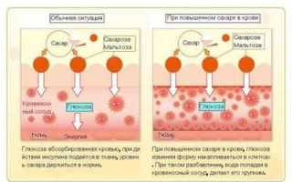 Сахарный диабет — как он проявляется при различных типах