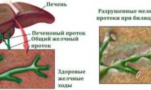 Первичный билиарный цирроз печени