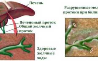Первичный билиарный цирроз печени