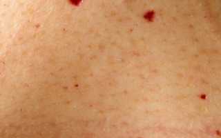 Красные точки Тужилина при панкреатите