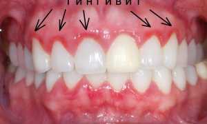 Почему важно лечить заболевания десен