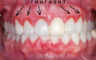 Почему важно лечить заболевания десен