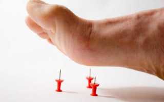 Диабетическая нейропатия – причины, признаки, лечение