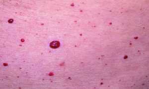 Высыпания на коже при болезнях поджелудочной железы