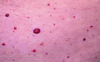 Высыпания на коже при болезнях поджелудочной железы