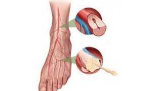 Ангиопатия ног при сахарном диабете и как ее лечить (с фото симптомов)