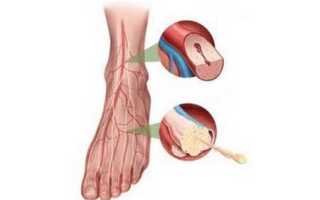 Ангиопатия ног при сахарном диабете и как ее лечить (с фото симптомов)