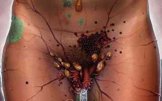 Половые болезни у женщин на фоне сахарного диабета