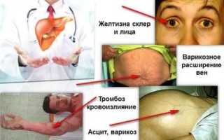 Продолжительность жизни при циррозе печени