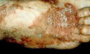 Что такое глюкагонома предстательной железы и как ее лечить (с фото)