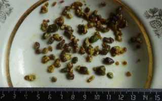 Камни в поджелудочной железе