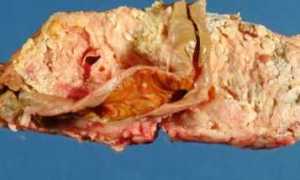 Что такое некроз поджелудочной железы