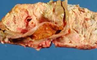 Что такое некроз поджелудочной железы