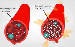 Что означает повышенная глюкоза в крови и моче