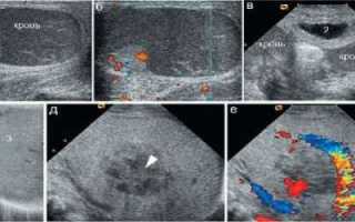 Что такое диффузные изменения поджелудочной железы