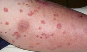 Зуд кожи при сахарном диабете