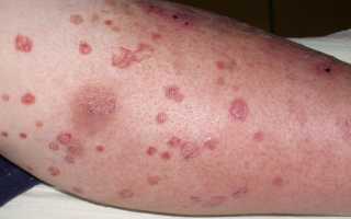 Зуд кожи при сахарном диабете