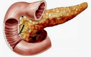 Что является причиной и симптомами панкреонекроза поджелудочной железы?
