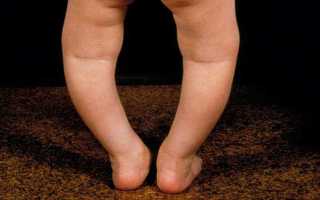 Фосфат диабет