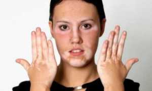 Сыпь на коже при сахарном диабете