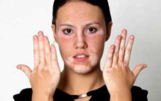 Сыпь на коже при сахарном диабете