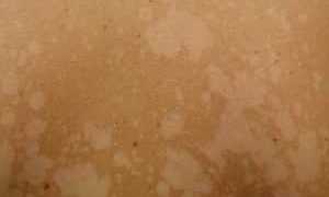 Кожные заболевания при сахарном диабете