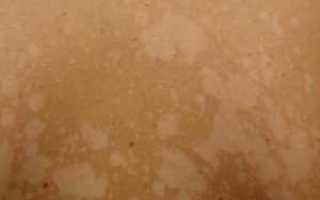 Кожные заболевания при сахарном диабете