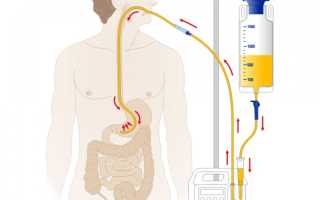 Что такое энтеральное питание?